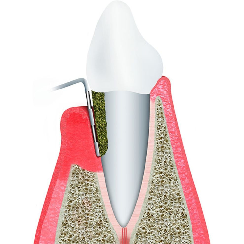 Lechenie-parodontita